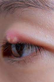 7 Ways To Treat Or Get Rid Of A Stye
