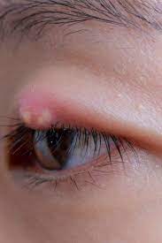 See full list on wikihow.com 7 Ways To Treat Or Get Rid Of A Stye