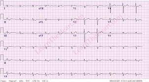 The qrs complex is narrow (0.10 sec or less). Accelerated Junctional Rhythm Ecg Learntheheart Com