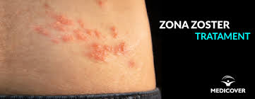 Incidența acestei afecțiuni în rândul copiiilor este foarte redusă. Zona Zoster Tratament