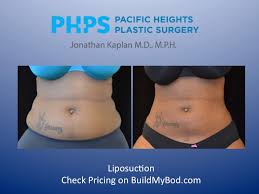It is ideal to have all 3 areas treated simultaneously for the best results. 5 Myths Of Liposuction Buildmybod Health