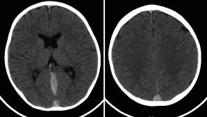 Que es una trombosis cerebral. Que Es Una Trombosis De Senos Venosos Causas Sintomas Y Tratamiento