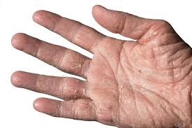 Image result for contact dermatitis