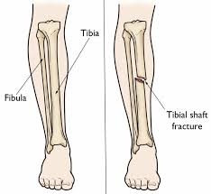 Maybe you would like to learn more about one of these? Fungsi Tulang Kering Bagi Manusia Adalah Dan Tips Menjaganya