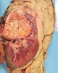 Complications can include spread to the lungs or brain. Renal Cell Carcinoma Wikipedia