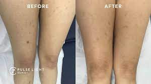Apply a skin product with salicylic acid to minimize or reduce ingrown hairs permanently. What Is Laser Hair Removal Pulse Light Clinic London