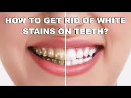 The professionals will be able to safely whiten your teeth with the knowledge of how to whiten sensitive teeth. Pin On White Teeth Quickly Easily