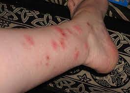 how to get rid of bed bugs everything you need to know bed bug bites rid of bed bugs remedies for mosquito bites