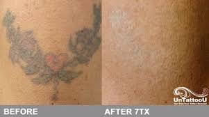 The piqo4 uses two cutting edge technologies to clear more color in a faster treatment. Picosure Laser Tattoo Removal Before And After Elegant Arts Tattoo