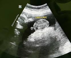 Dengan begitu mama akan dengan mudah mengetahui letak calon bayi ya. Usg 4 Dimensi Kehamilan Halaman 1 Kompasiana Com