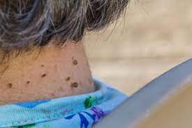 Generally, these thrombosed skin tags will fall off on their own in about 3 to 10 days. Did You Know That Skin Tags May Be An Early Sign Of Insulin Resistance