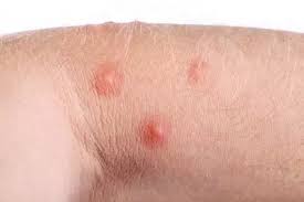 What Are The Symptoms Associated With Black Ant Bites Quora