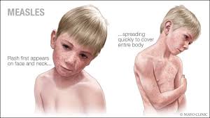 Image result for Measles