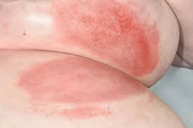 Image result for sore skin in the groin area