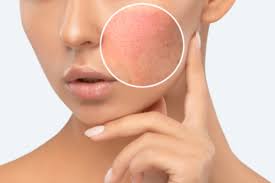 Image result for contact dermatitis