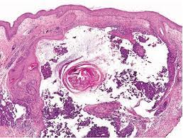 Inflammatory Diseases Of Hair Follicles Sweat Glands And Cartilage Plastic Surgery Key