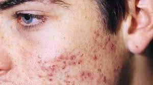 Las Posibles Maneras De Controlar El Acne Para Todos As Com