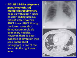 18 Airspace Diseases Dr Muhammad Bin Zulfiqar
