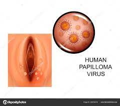 hpv related lung cancer hpv and lung cancer risk grandordeluxe ro