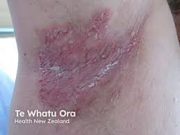 Image result for Intertrigo under breasts