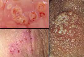 We did not find results for: Ù…Ø±Ø¶ Ø§Ù„Ù‡Ø±Ø¨Ø³ Ø§Ù„ØªÙ†Ø§Ø³Ù„ÙŠ Genital Herpes Ù‚Ù†Ø§Ø© Ø§Ù„Ø¹Ø±Ø§Ù‚ Ø§Ù„Ø·Ø¨ÙŠØ© Facebook