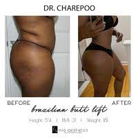 At mia aesthetics we provide the highest quality plastic surgery, all at affordable prices. Bbl Before And After Pictures