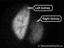 Dimercaptosuccinic acid (dmsa), also called succimer, is a medication used to treat lead, mercury, and arsenic poisoning. Dmsa Renal Scan