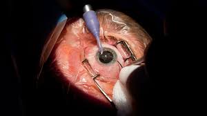 Image result for Cataract Extraction