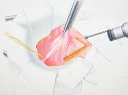 جراحة الناسور الشرجي بالليزر تونس بأسعار مغرية