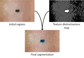 But the most common type of skin cancer is basal cell carcinoma, which is. Skin Cancer Detection Vision And Image Processing Lab University Of Waterloo
