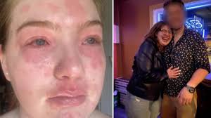 Wajahnya Merah, Wanita Ini Alergi Tiap Bertemu Pacarnya dan Kesakitan  Setelah Bertemu, Kok Bisa?