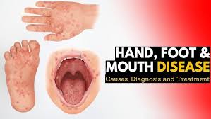 Image result for Hand foot and mouth disease HFMD roof of mouth