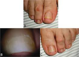 Image result for Onycholysis feet
