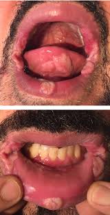 Image result for syphilis ulcer