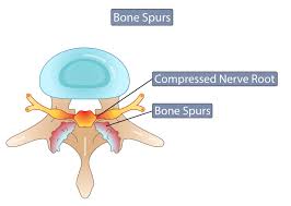 Search spur definition & word meaning in english. Bone Spurs Symptoms Causes What Is A Bone Spur Mnc