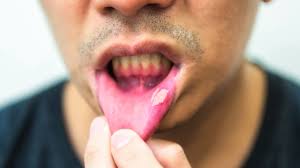 Image result for Canker sores symptoms roof of the mouth