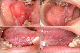 Image result for lichen planus on tongue)