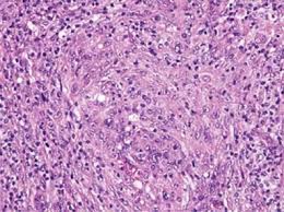 Dr flora poon, victorian dermatology registrar, st. Https Www Longdom Org Open Access The Tcell Predominance Angioimmunoblastic Tcell Lymphoma Pdf