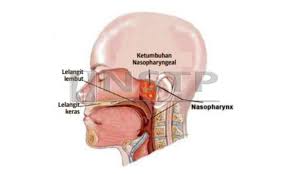 Sila klik pada link ini (doctoroncall) untuk bercakap dengan pihak kami. Lelaki Berisiko Tinggi Hidap Kanser Hidung