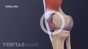 Image result for gout symptoms knee