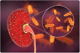 Image result for Acute Pyelonephritis