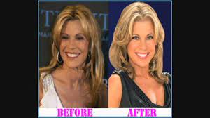 Recent photos appear to show less heaviness of her . Vanna White Plastic Surgery Youtube