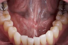 They may look like a patch or a lump or look like an ulcer. Self Oral Cancer Screening Socs Education Program School Of Dentistry Lsu Health New Orleans