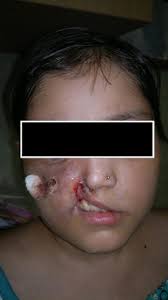 Mucormycosis, also known as zygomycosis, is a rare fungal infection caused by the fungus mucoromycotina (order murcorales). Rhino Orbital Mucormycosis With Palatal Involvement In A Child With Type 1 Diabetes Mellitus Sciencedirect