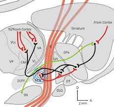 Image result for Thalamic Stimulation