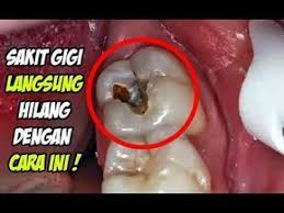 Tips Cara Mengobati Sakit Gigi Berlubang Secara Ampuh Carakupedia Di 2020 Obat Alami Kesehatan Gigi Kesehatan Pria