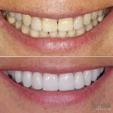 Veneers Before And After Smile Teeth Porcelain Veneers White Teeth