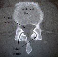Sep 12, 2016 · facet joints in your spine are the ones that help make your back more flexible. Facet Joint Syndrome And Treatment Options Texas Spine Center