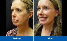 Turkey neck is caused by a combination of loose skin, untoned muscles, and fat. How To Get Rid Of Turkey Neck With Plastic Surgery Scripps Health