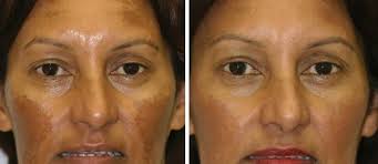 Image result for Melasma